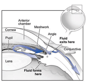 Glaucoma before surgery