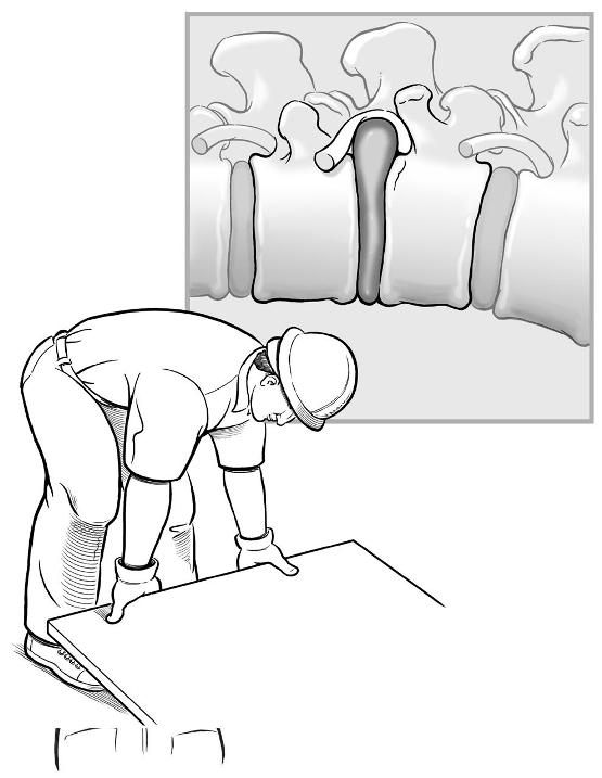 If you bend forward over and over for months or years, the discs are weakened, which may lead to disc rupture (or