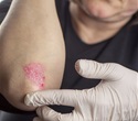 Innovative vibroacoustic sensor could revolutionize eczema and psoriasis treatment