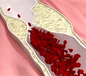 Immune cell energy metabolism shapes the progression of atherosclerosis