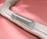 Coronary stent drives Johnson & Johnson to record profits