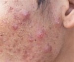 Adult Acne - Skin Disorders