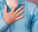 Hyperhidrosis - Excessive Sweating