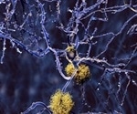 Researchers identify enzyme linked to myelin damage and neurodegenerative conditions