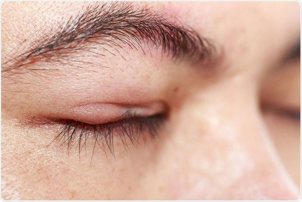 Close up right upper eye lid abscess