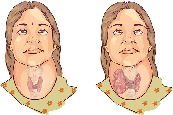 Goiter - Image Copyright: corbac40 / Shutterstock