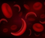 Sickle cell trait may not increase mortality risk