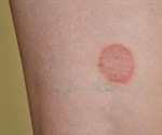Lichen Planus (LP) Skin Condition