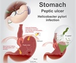 Living with Peptic Ulcer Disease