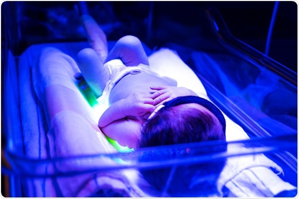 Newborn infant baby boy receiving phototherapy for jaundice at the hospital. Image Copyright: Melpomene / Shutterstock, Inc