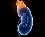 Web-based tool could aid in early detection and prevention of chronic kidney disease