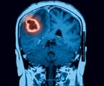 Intracerebral Hemorrhage (ICH)