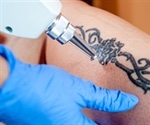 The Benefits and Risks of Laser Tattoo Removal