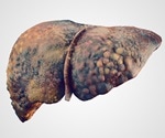 Repurposed drug combination shows strong promise against liver fibrosis