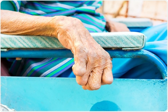 closeup hand of old man suffering from leprosy, amputated hand, on wheelchair - Image Credit: Tidarat Tiemjai / Shutterstock