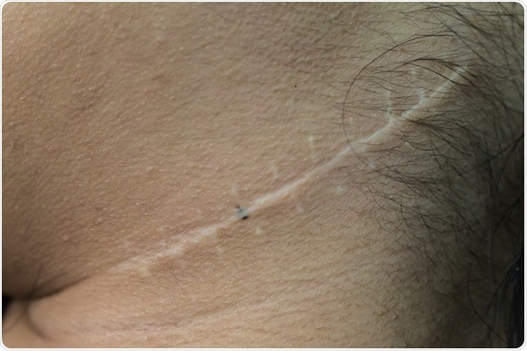 Scar from operation on neck - Image Credit: Ratchaya Nonthanaphat / Shutterstock