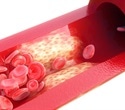 Novel nanomedicine mPEG@ELA-11 shows potential in treating atherosclerosis
