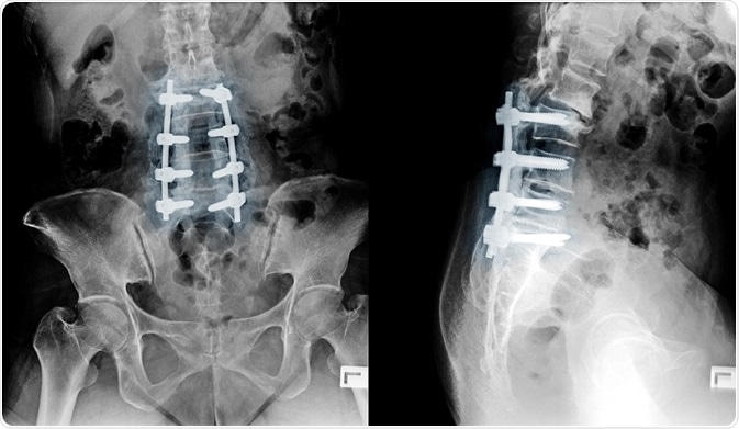Bioactive glass bone graft