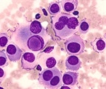 Metastatic Melanoma