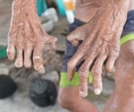 Genetic analysis shows leprosy was endemic in pre-colonial America