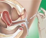 Intrauterine Insemination (IUI) vs IVF