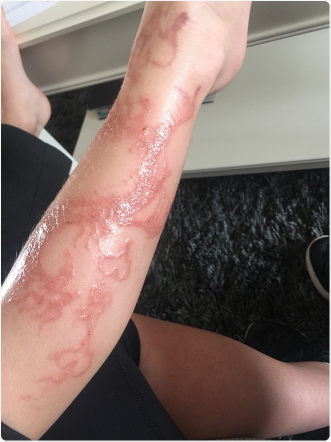 Scar from Black Henna tattoos