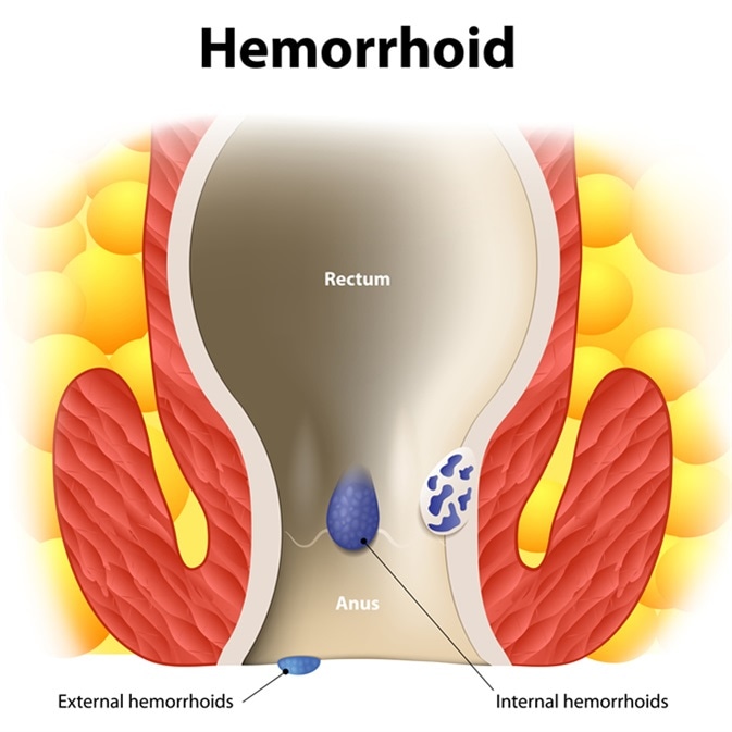 Diagram the anal anatomy. internal and external hemorrhoids. Human anatomy - Imnage Credit: Designua / Shutterstock
