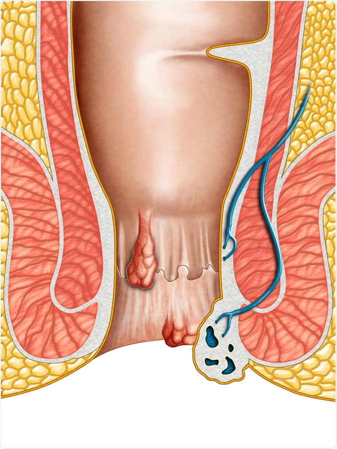 Anatomical drawing showing internal and external hemorrhoids. Digital illustration. Image Credit: Andrea Danti / Shutterstock