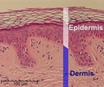 Types of Epidermal Nevi
