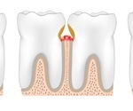 Management of Periodontitis