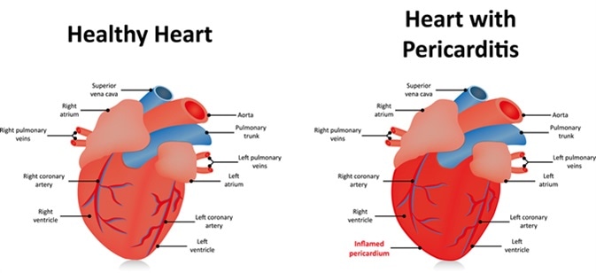 Pericarditis. Image Credit: Joshya / Shutterstock