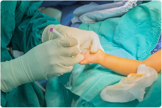 Hand surgery in Syndactyly. Image Credit: Samrith Na Lumpoon / Shutterstock