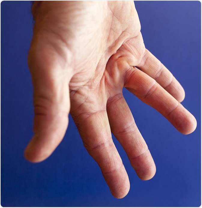 Hand of an man with Dupuytren contracture disease. Image Credit: Fineart1 / Shutterstock