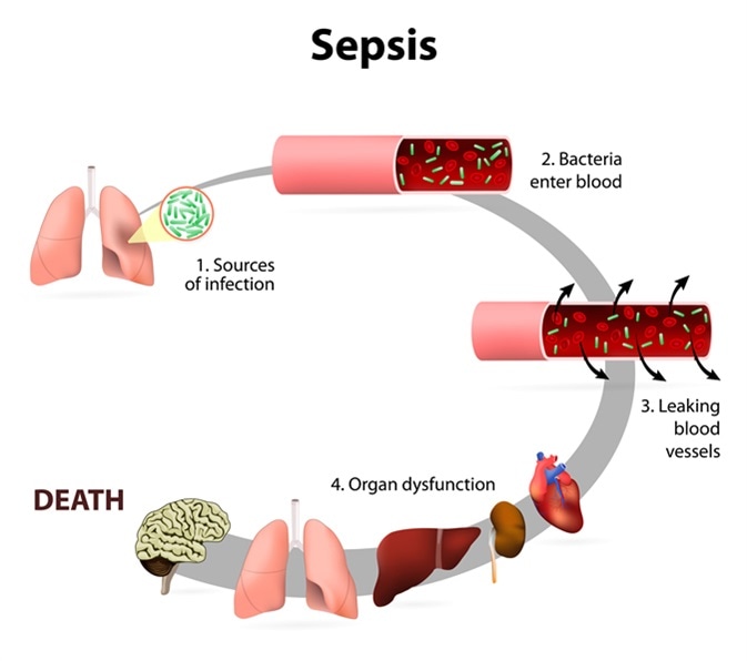 Effects of sepsis. Presence of numerous bacteria in the blood, causes the body to respond in organ dysfunction. Image Credit: Designua / Shutterstock