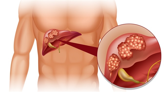 Liver cancer in human illustration. Image Credit: BlueRingMedia / Shutterstock