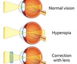 Hyperopia (Far-Sightedness)