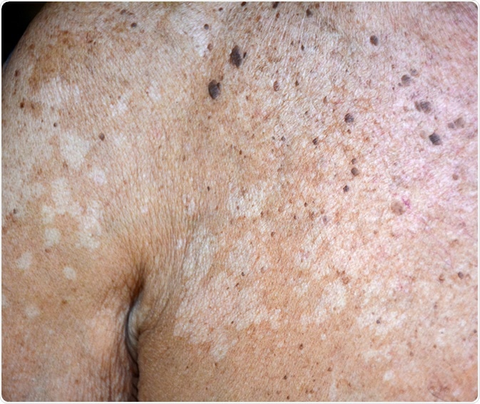 Tinea versicolor/Pityriasis versicolor on the skin. Image Credit: sutham / Shutterstock