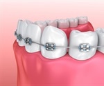 Types of Dental Braces