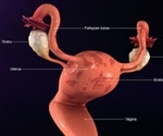 What is Endometrial Hyperplasia?