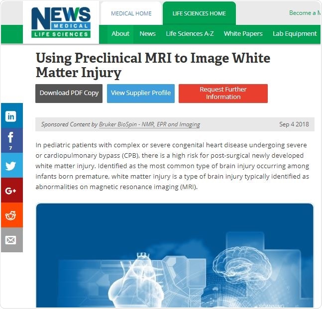 White Matter Injury Article Example