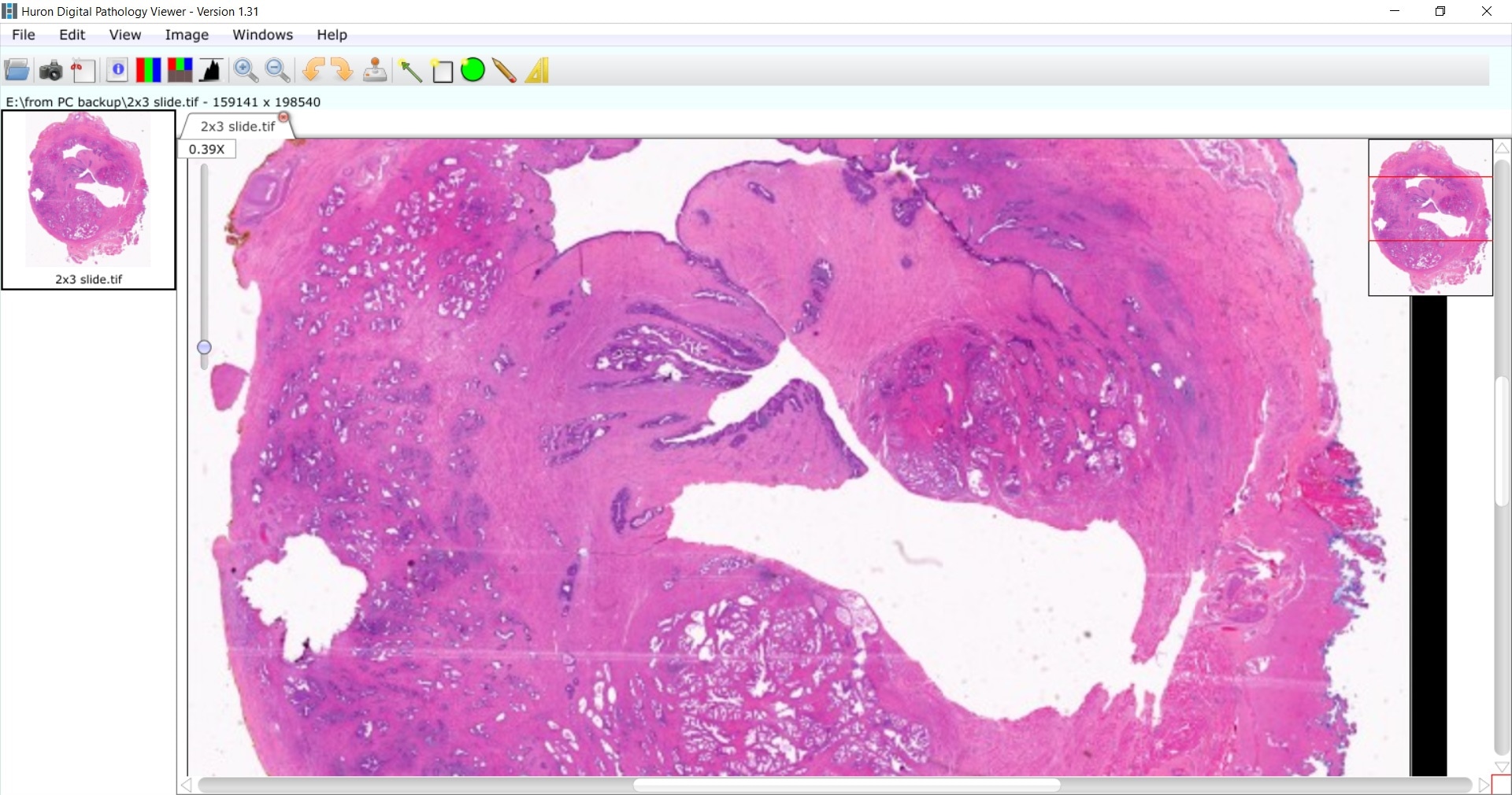 prostate cancer sample