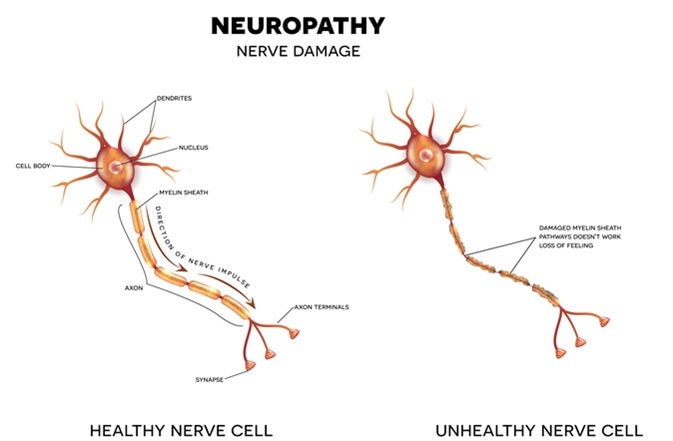 Neuropathy that is the damage of nerves. Image Credit: Tefi / Shutterstock