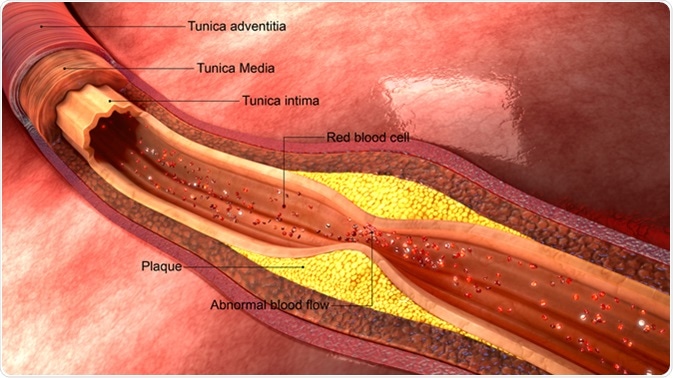 Atherosclerosis. Image Credit: sciencepics / Shutterstock