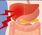 Symptoms of Gallbladder Cancer