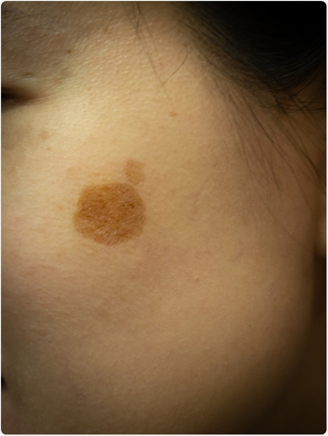 Hyperpigmentation on woman face. Image Credit: Amawasri Pakdara / Shutterstock