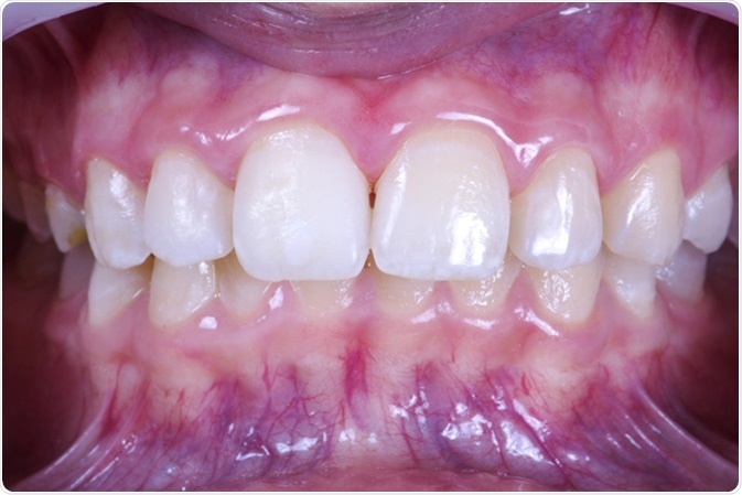 Local tooth enamel hypoplasia. Surface after remineralization. Image Credit: Eduard Tanga / Shutterstock