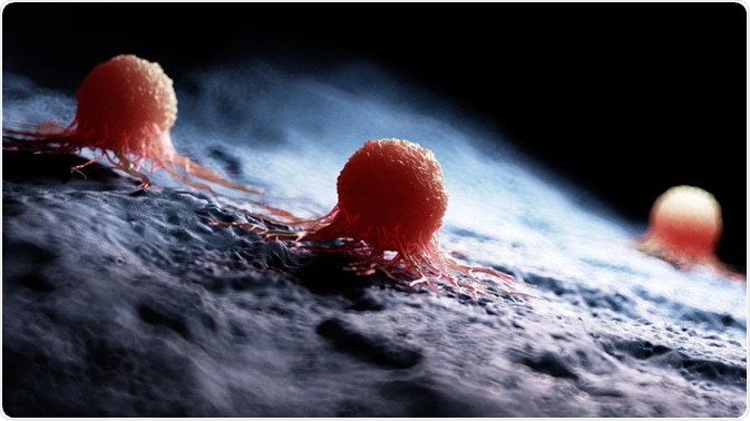 Illustration of a carcinoma - By Sebastian Kaulitzki