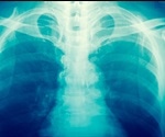 X-rays may double the risk of cancer for obese patients