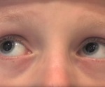 Leber Congenital Amaurosis Diagnosis