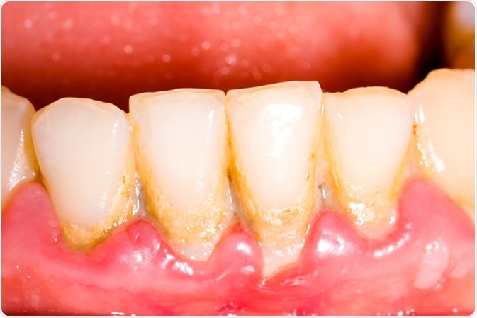 Unhealthy denture, tartar on frontal teeth, plaque and gingivitis. Image Credit: Botazsolti / Shutterstock